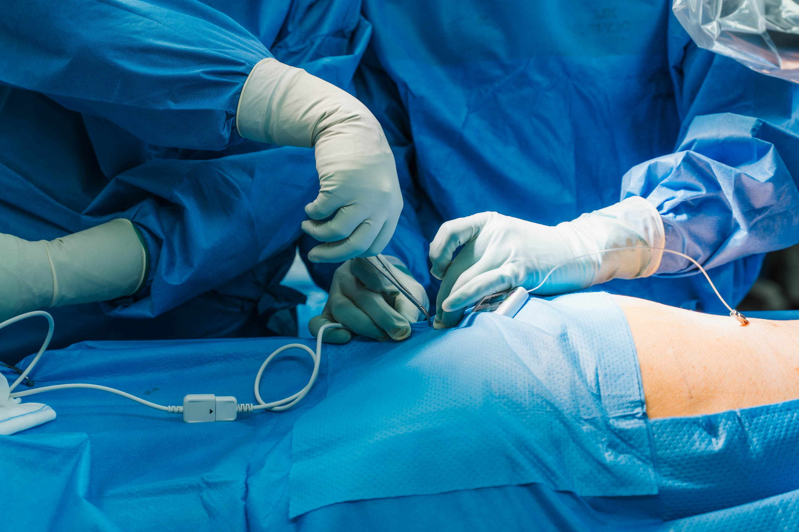 Neuromodulation Surgery